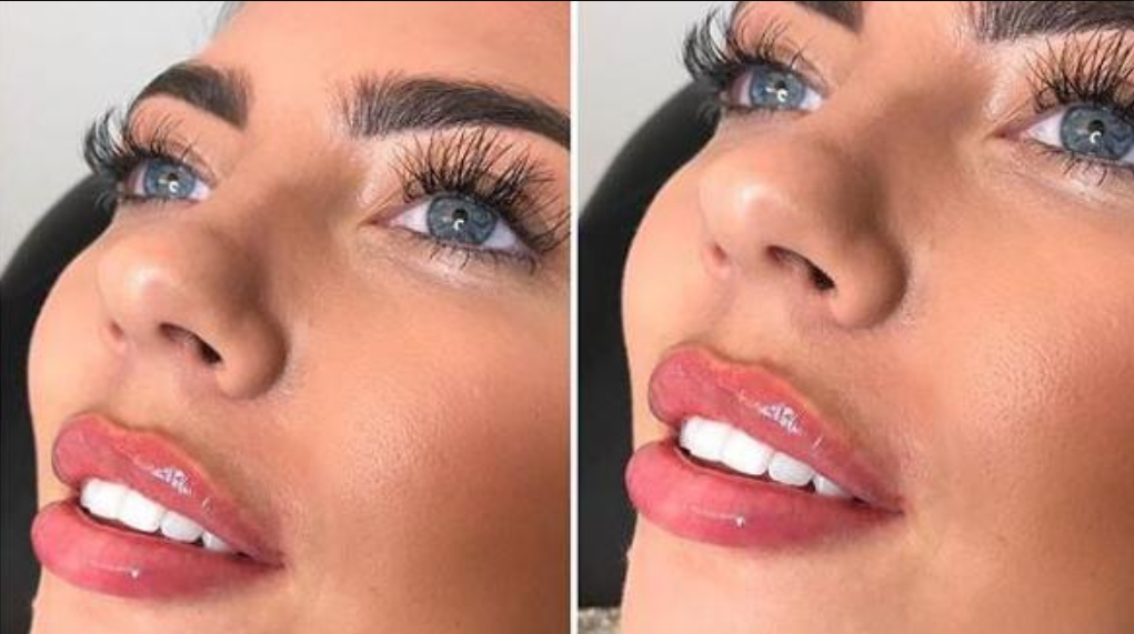 Teen’s Lip Filler Appointment Goes Wrong: Emma Williams ‘Bawls Eyes Out’ After Mirror Shock 3 image 433